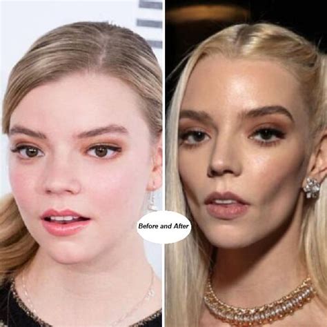 Anya Taylor Joy teeth then and now: before and after surgery。